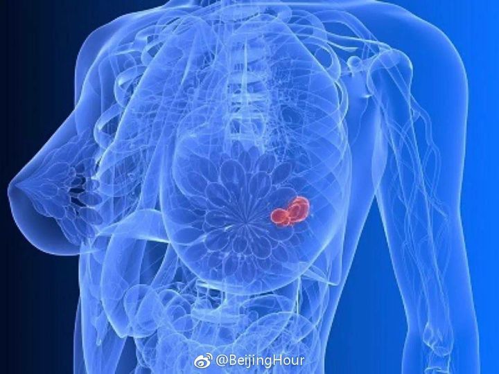 จีนเผย เตรียมใช้ AI-ปัญญาประดิษฐ์วินิจฉัยมะเร็งเต้านม 

“วันนี้อ้ายจงได้ยินข่าวเ…