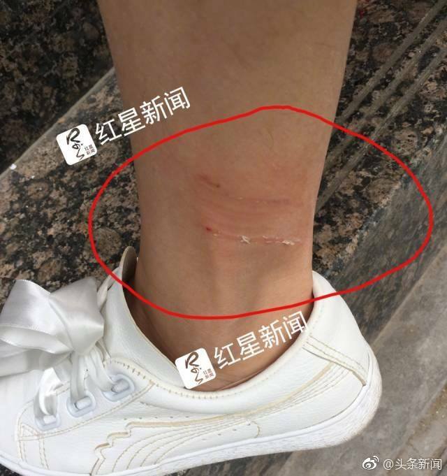 #สรุป กรณีสาวจีนวัย 32 ปี เสียชีวิตด้วยโรคพิษสุนัขบ้า หลังถูกสุนัขกัด 28 วัน แม้…
