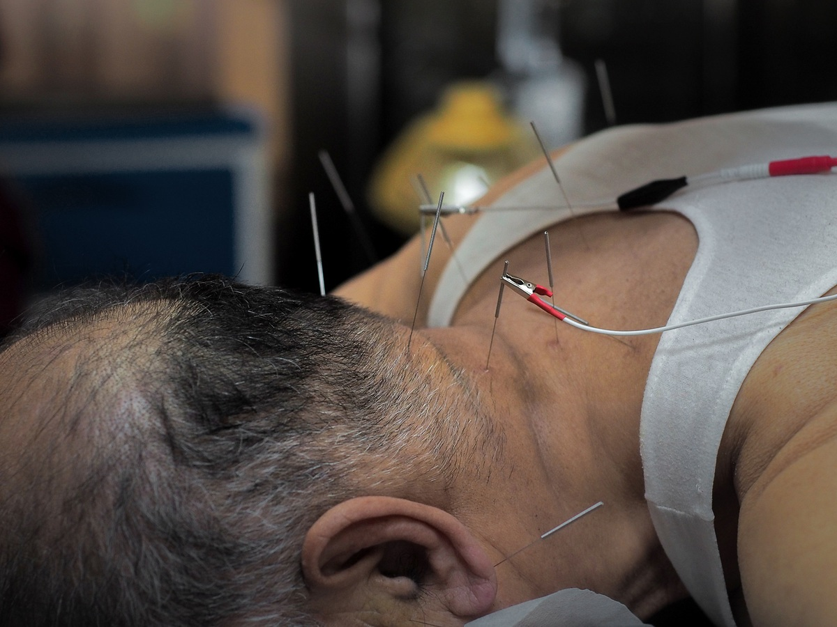 นักวิทย์จีนรักษาอาการกลืนลำบากด้วยวิธีฝังเข็มกระตุ้นไฟฟ้า